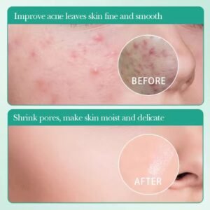 Salicylic Acid Sheet Mask Acne Treatment Three-Step Moisturizing Smooth Skin Care Facial Mask